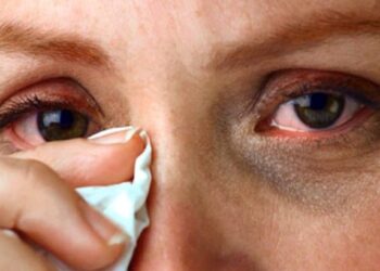 तुमचेही डोळे आले आहेत का ? जाणून घ्या घ्यावयाची काळजी