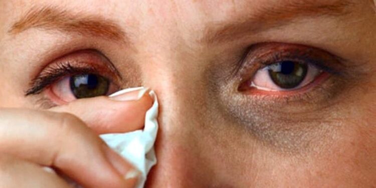 तुमचेही डोळे आले आहेत का ? जाणून घ्या घ्यावयाची काळजी