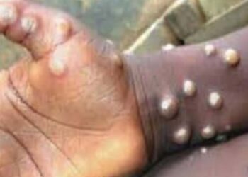 मंकीपॉक्स संदर्भात केंद्राने राज्य सरकारांना दिल्या मार्गदर्शक सूचना; वाचा काय आहेत?